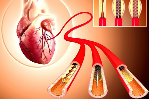 coronary-angioplasty