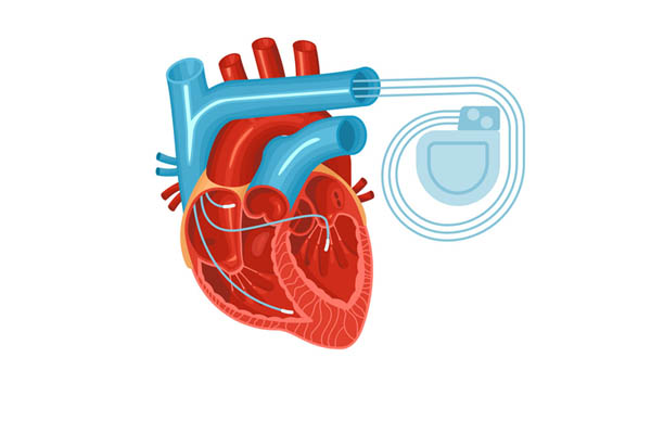 pacemaker-implantation