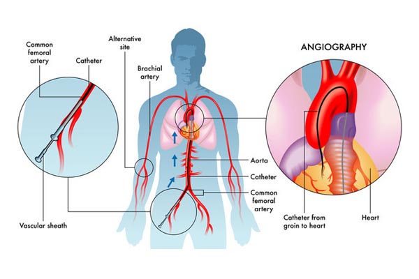 coronary-angiography